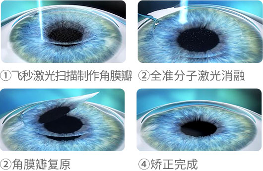 飛秒激光近視手術