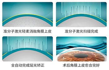 全飛秒激光近視手術(shù)